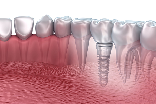 dental implants in North York