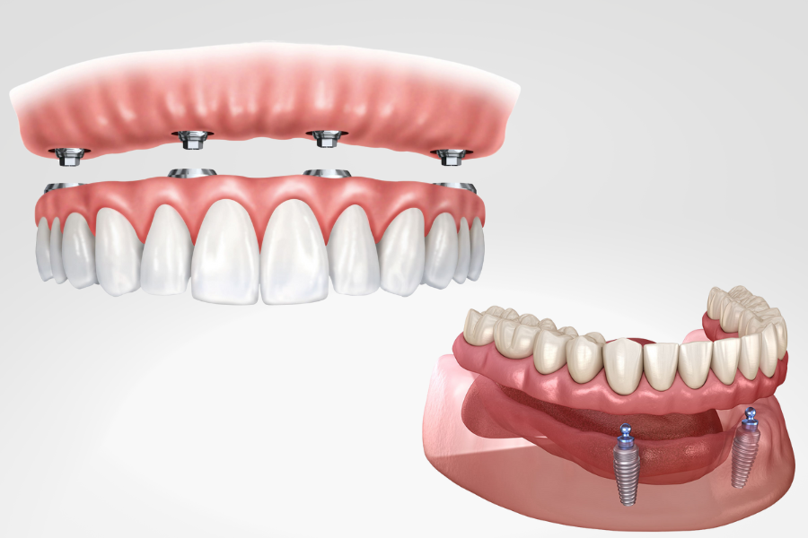 implant-overdentures-north-york